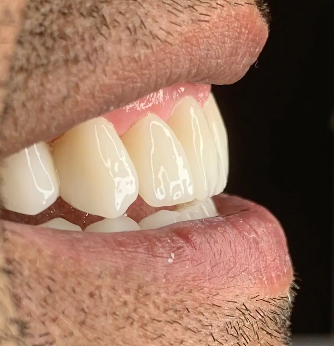 Real patient result — Dr. Türker Yücesoy