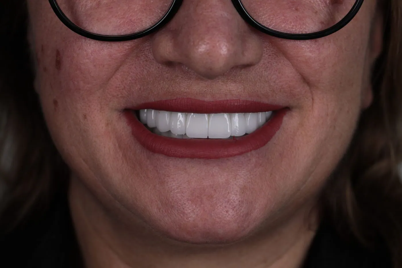 Real patient result — Dr. Türker Yücesoy
