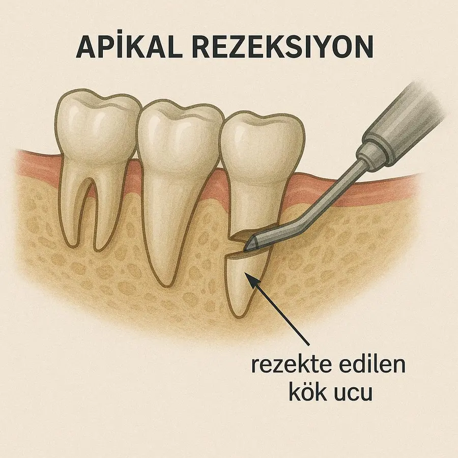 Résection apicale