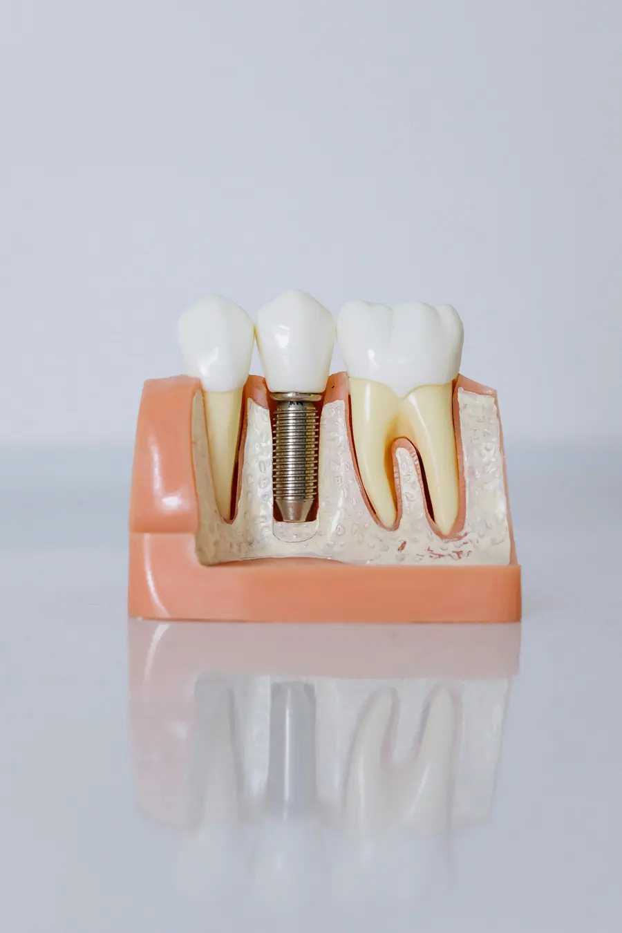 Modèle d’implant dentaire