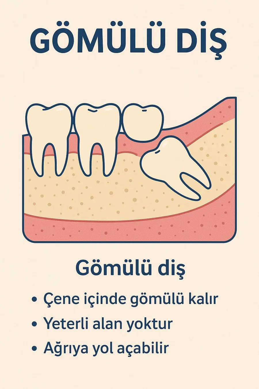 Illustration d’une dent incluse