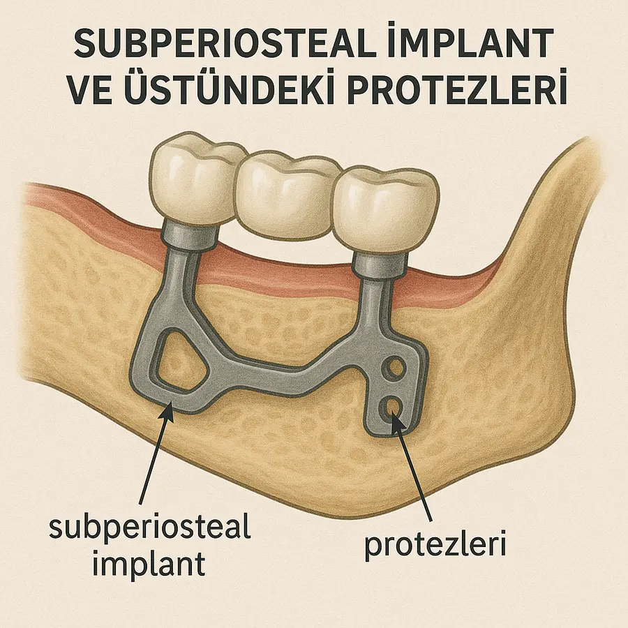 Implant sous-périosté et prothèses